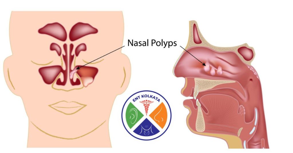 Nasal polyps - Symptoms and causes – Ear-Nose-Throat (ENT) Specialists ...